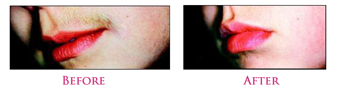 Unwanted Hair Removal, Hair Removal Solution